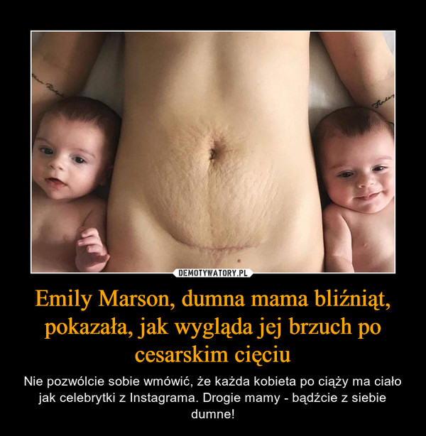 Emily Marson, dumna mama bliźniąt, pokazała, jak wygląda jej brzuch po cesarskim cięciu – Nie pozwólcie sobie wmówić, że każda kobieta po ciąży ma ciało jak celebrytki z Instagrama. Drogie mamy - bądźcie z siebie dumne! 
